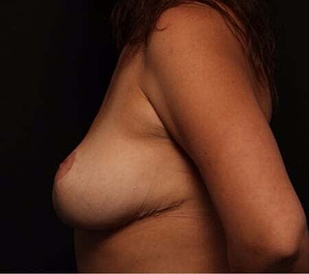 Breast Lift Before & After