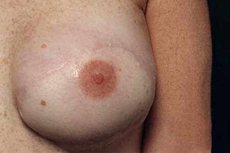 Nipple Tattoo Before & After