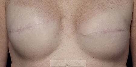 Nipple Tattoo Before & After