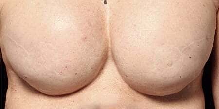 Nipple Tattoo Before & After