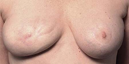Nipple Tattoo Before & After