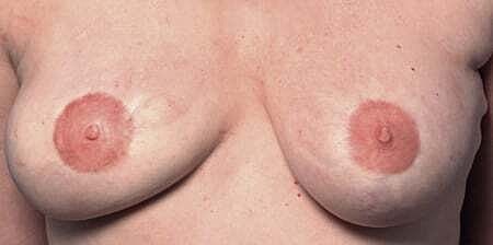 Nipple Tattoo Before & After