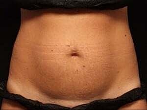 Coolsculpting Before & After