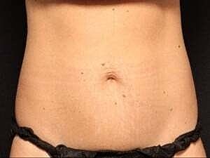 Coolsculpting Before & After
