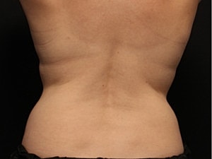 Coolsculpting Before & After