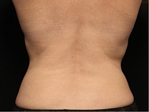 Coolsculpting Before & After