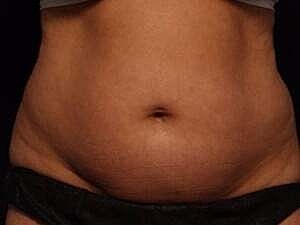 Coolsculpting Before & After