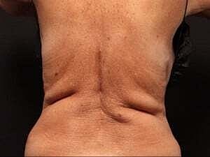 Coolsculpting Before & After