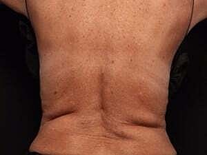 Coolsculpting Before & After