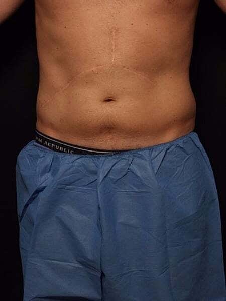 Coolsculpting Before & After
