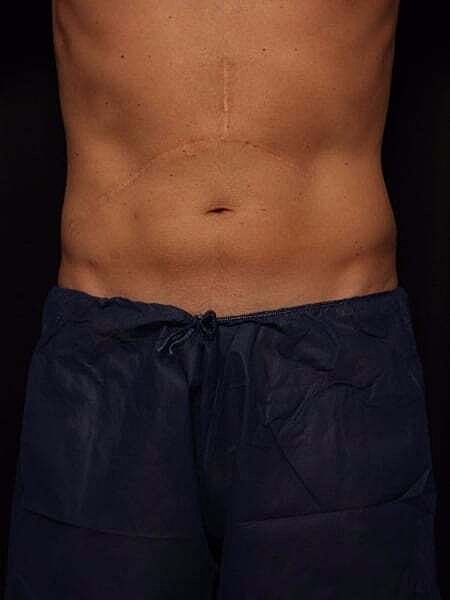 Coolsculpting Before & After
