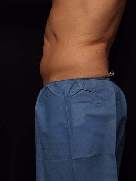 Coolsculpting Before & After