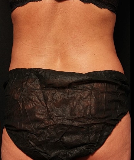 Coolsculpting Before & After