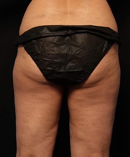 Coolsculpting Before & After