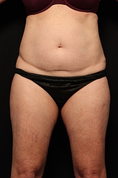 Coolsculpting Before & After