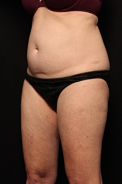 Coolsculpting Before & After