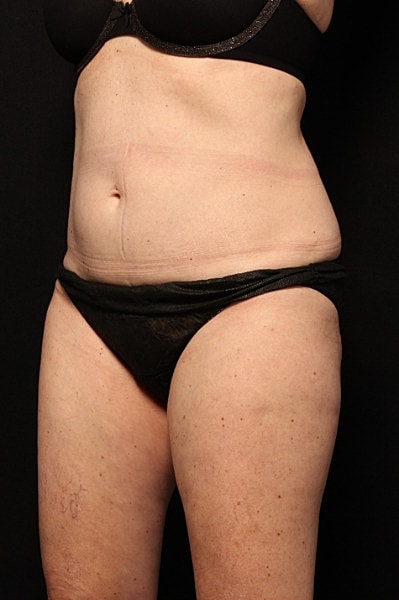 Coolsculpting Before & After