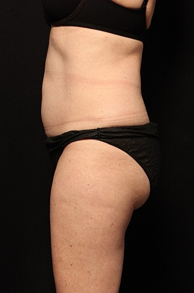 Coolsculpting Before & After