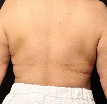 Coolsculpting Before & After