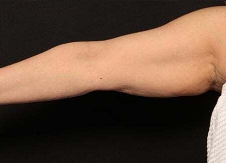 Coolsculpting Before & After