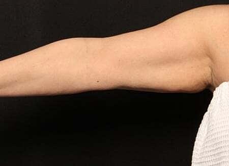 Coolsculpting Before & After