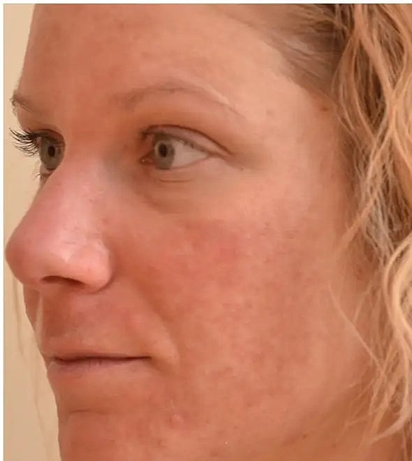 Why choose Halo over other laser procedures