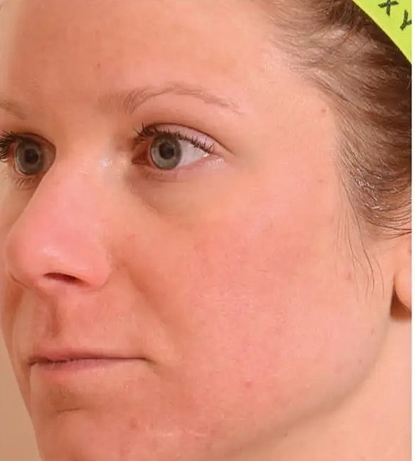 Why choose Halo over other laser procedures
