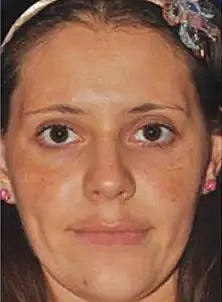 Before and after skinpen treatments