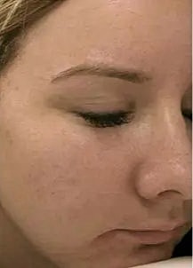 Before and after skinpen treatments