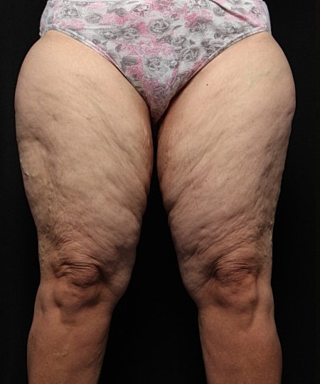 Thigh Lift Before & After