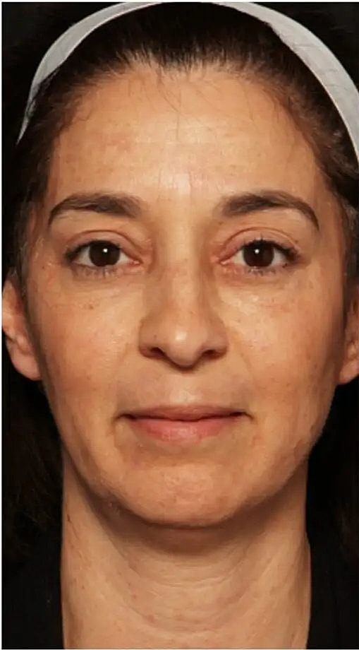 Laser Skin Resurfacing with Erbium Laser