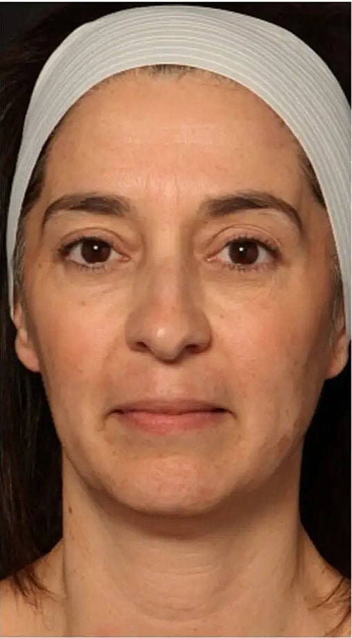 Laser Skin Resurfacing with Erbium Laser