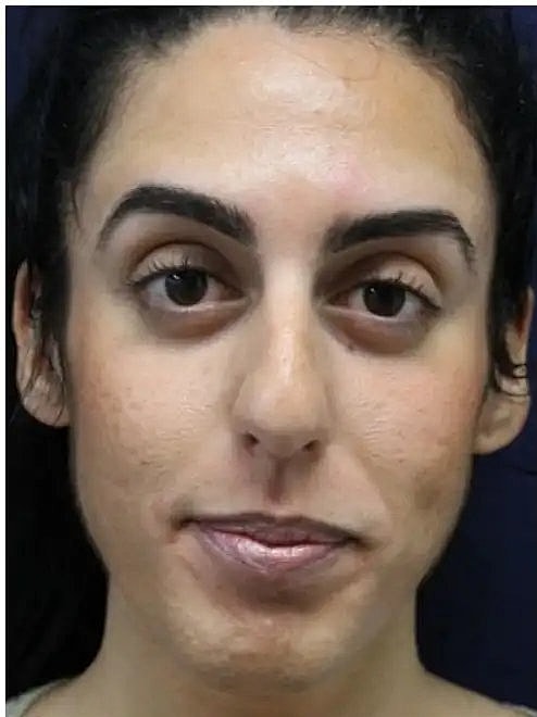 laser resurfacing to renew face skin
