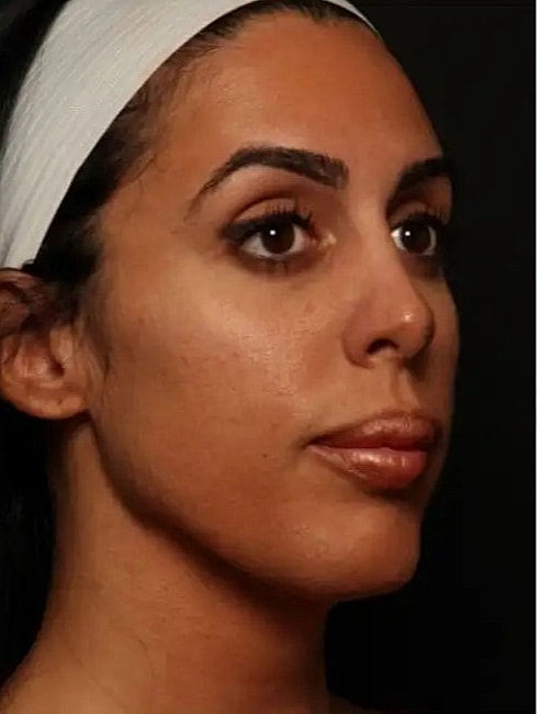 laser resurfacing to renew face skin