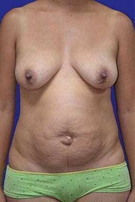 Mommy Makeover Before & After
