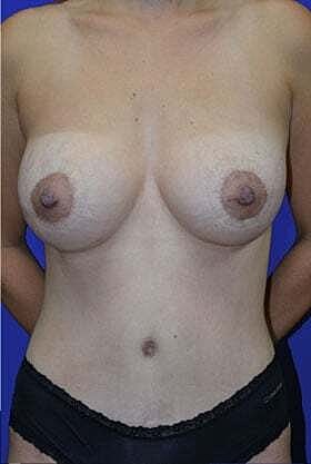 Mommy Makeover Before & After