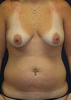 Mommy Makeover Before & After
