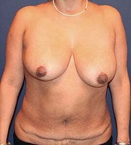 Mommy Makeover Before & After