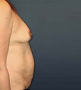 Mommy Makeover Before & After