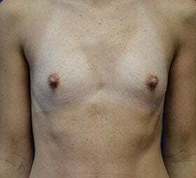 Breast Augmentation Before & After