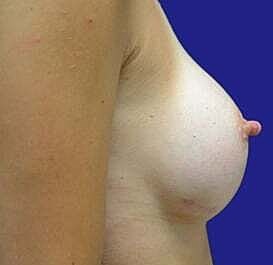 Breast Augmentation Before & After