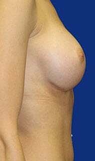 Breast Augmentation Before & After