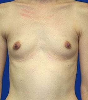 Breast Augmentation Before & After