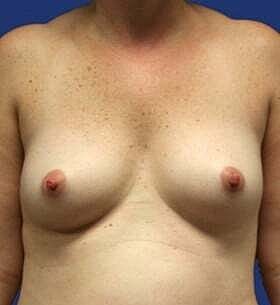 Breast Augmentation Before & After