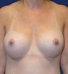 Breast Augmentation Before & After