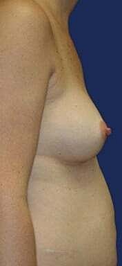 Breast Augmentation Before & After