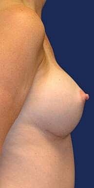 Breast Augmentation Before & After