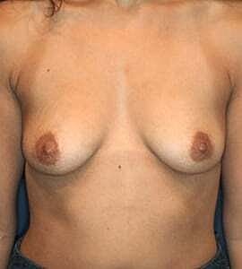 Breast Augmentation Before & After
