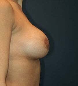 Breast Augmentation Before & After