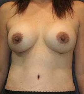 Breast Augmentation Before & After